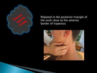 Palpated in the posterior triangle of
the neck close to the anterior
border of trapezius
 