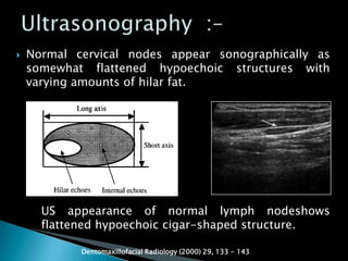  Normal cervical nodes appear sonographically as
somewhat flattened hypoechoic structures with
varying amounts of hilar fat.
Dentomaxillofacial Radiology (2000) 29, 133 - 143
US appearance of normal lymph nodeshows
flattened hypoechoic cigar-shaped structure.
 
