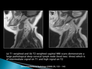 (a) T1 weighted and (b) T2 weighted sagittal MRI scans demonstrate a
large pathological deep cervical lymph node (level two/ three) which is
of intermediate signal on T1 and high signal on T2
Dentomaxillofacial Radiology (2000) 29, 133 - 143
 