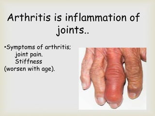 Arthritis is inflammation of
joints..
•Symptoms of arthritis;
joint pain.
Stiffness (
(worsen with age).
 