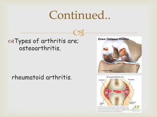 
Types of arthritis are;
osteoarthritis.
rheumatoid arthritis.
Continued..
 