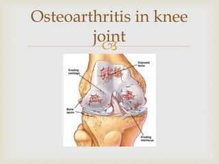 
Osteoarthritis in knee
joint
 