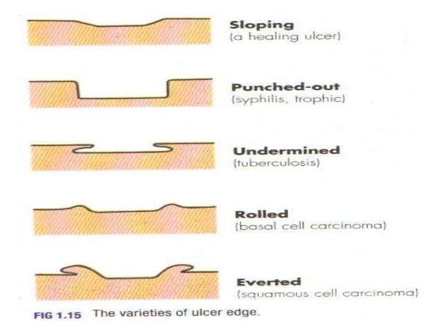 Venous Skin Ulcer - Topic Overview - WebMD