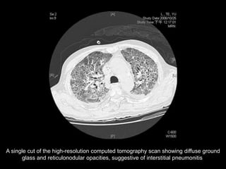 Approach To Interstitial Lung Diseases | PPTX