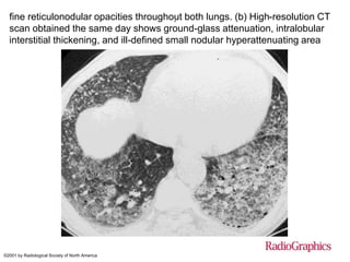 Approach To Interstitial Lung Diseases | PPTX