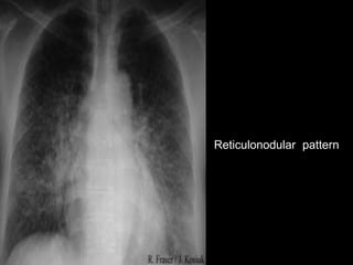 fine reticulonodular opacities throughout . 
both lungs. (b) High-resolution CT 
scan obtained the same day shows ground-g...