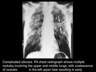 Simple silicosis. 
A: CT scan with lung windowing shows numerous 
circumscribed pulmonary nodules, 2 to 3 mm in diameter 
...