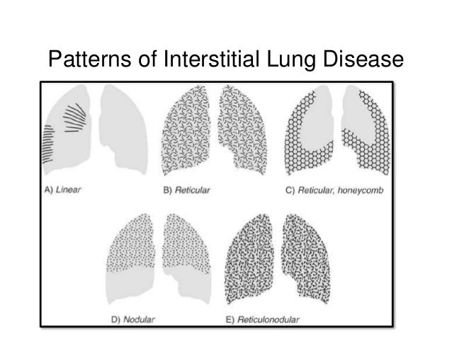 Lung Pattern Classification | approach to interstitial lung diseases Lung Pattern Classification | approach to interstitial lung diseases