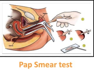 Pap Smear test
 