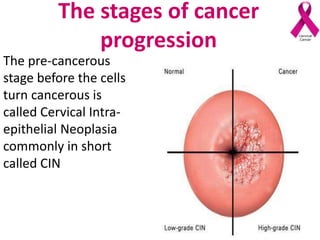 The stages of cancer
progression
The pre-cancerous
stage before the cells
turn cancerous is
called Cervical Intra-
epithelial Neoplasia
commonly in short
called CIN
 