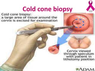 Cold cone biopsy
 