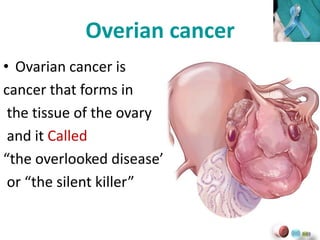 Overian cancer
• Ovarian cancer is
cancer that forms in
the tissue of the ovary
and it Called
“the overlooked disease”
or “the silent killer”
 
