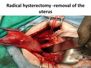 Radical hysterectomy -removal of the
uterus
 
