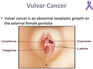 Vulvar Cancer
• Vulvar cancer is an abnormal neoplastic growth on
the external female genitalia
 