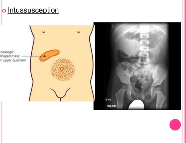 Abdominal pain in pediatric age group