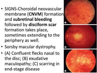 MACULAR DYSTROPHIES | PPTX