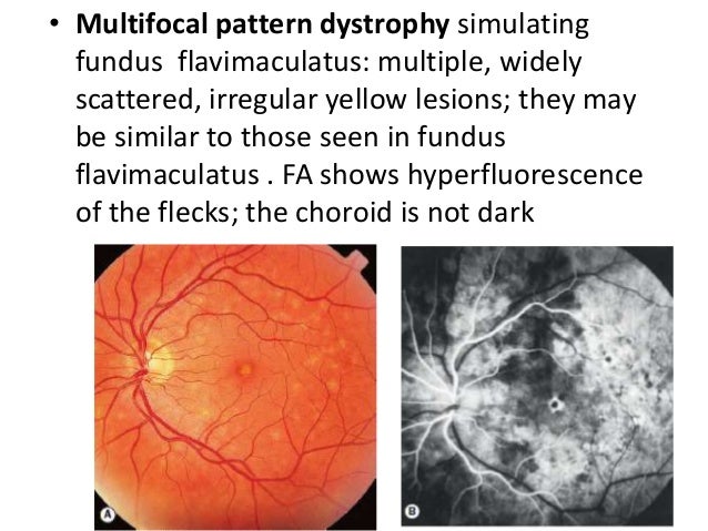 Multifocal Pattern Dystrophy Simulating Fundus Flavimaculatus | macular dystrophies Multifocal Pattern Dystrophy Simulating Fundus Flavimaculatus | macular dystrophies