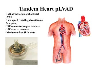 •Left atrial-to-femoral arterial
LVAD
•Low speed centrifugal continuous
flow pump
•21F venous transeptal cannula
•17F arterial cannula
•Maximum flow 4L/minute
Tandem Heart pLVAD
 