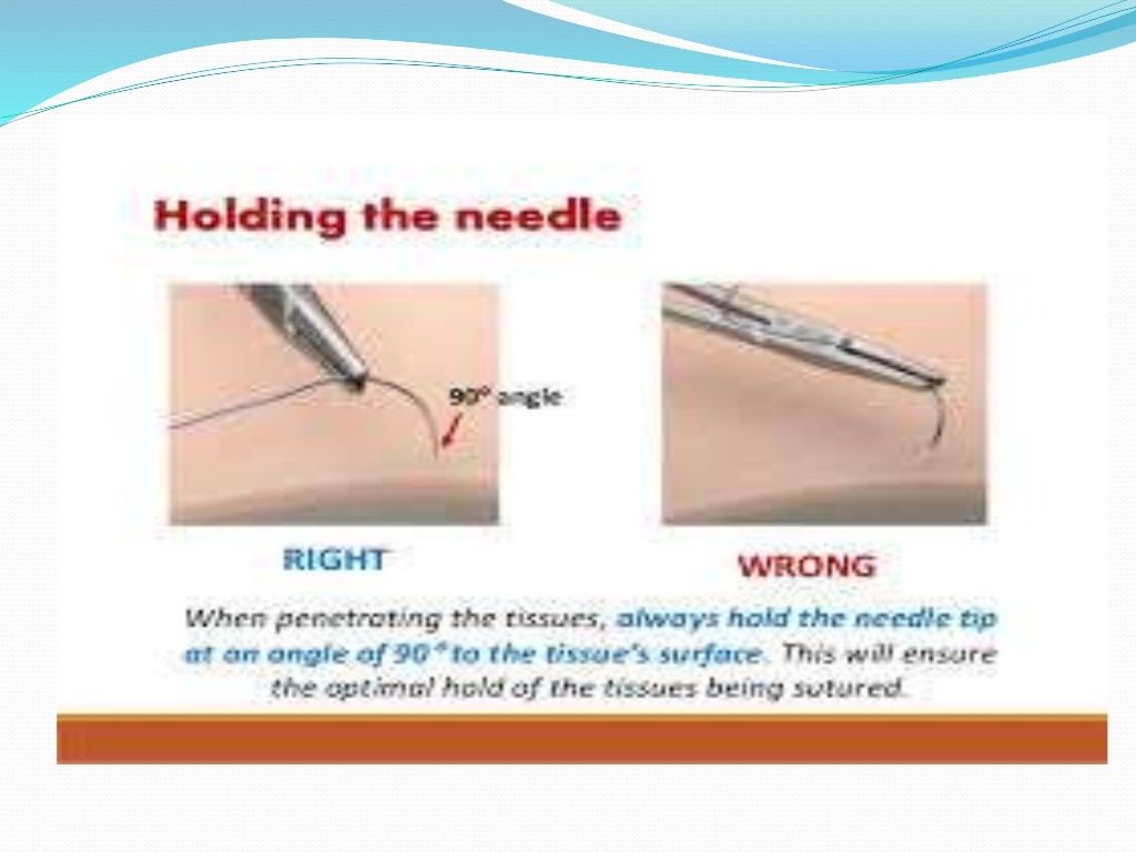 sutures and needles in ophthalmology