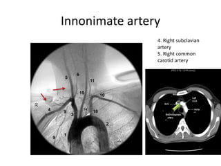 High Riding Innomate Artery ARTERIAL AND VENOUS SUPPLY OF BRAIN | PPTX