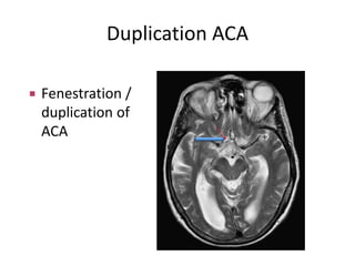 ARTERIAL AND VENOUS SUPPLY OF BRAIN | PPTX