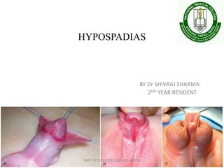 HYPOSPADIAS
BY Dr SHIVRAJ SHARMA
2ND YEAR RESIDENT
DEPT OF PEDIATRIC SURGERY,NMCTH
 