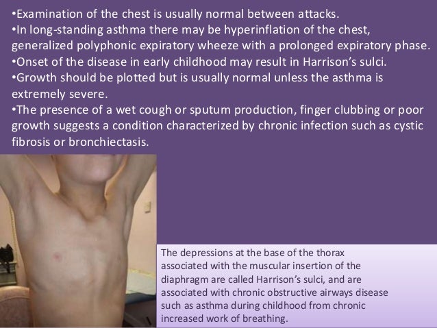 29+ Harrison&#039;s Sulcus Vs Subcostal Recession PNG