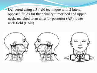  Delivered using a 3 field technique with 2 lateral
opposed fields for the primary tumor bed and upper
neck, matched to an anterior-posterior (AP) lower
neck field (LAN)
 