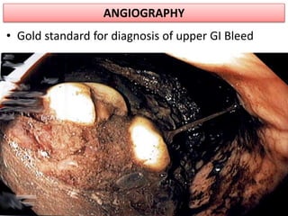 ANGIOGRAPHY
• Gold standard for diagnosis of upper GI Bleed
 