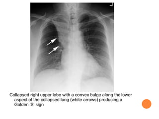 BENIGN AND MALIGNANT LUNG NEOPLASAM MASSES | PPTX