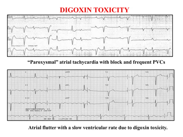 ECG abnormalities in drugs, temperature, electrolyte , metabolic and ...