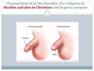 Circumcision (Cut the foreskin ,for religious in
Muslim and also in Christian and hygiene purpose
 
