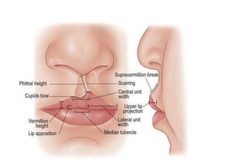 Secondary cleft lip deformities | PPTX