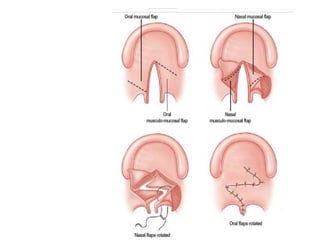 Speech assessment in cleft patients | PPTX