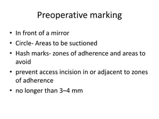 Preoperative marking
• In front of a mirror
• Circle- Areas to be suctioned
• Hash marks- zones of adherence and areas to
avoid
• prevent access incision in or adjacent to zones
of adherence
• no longer than 3–4 mm
 