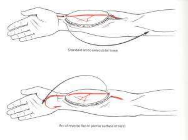 Tissue Rearrangement Arm Soft tissue reconstruction of the upper extremity.pptx