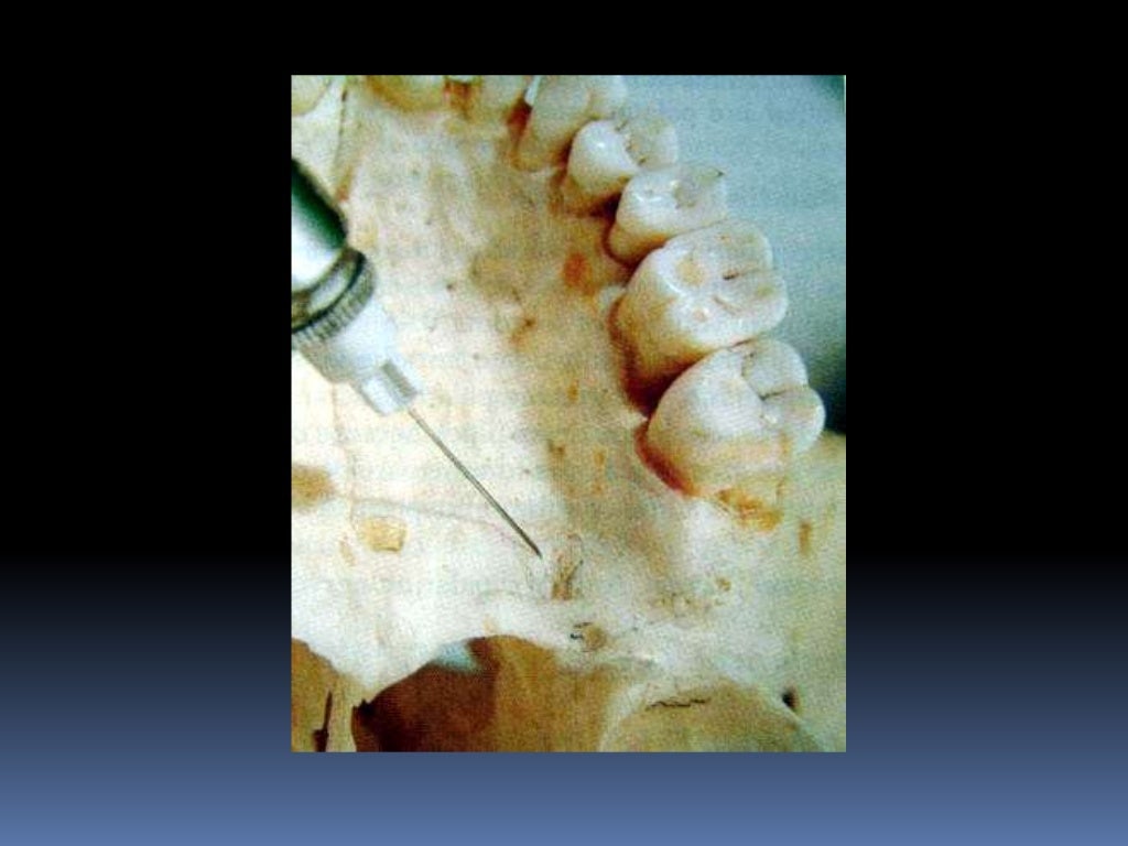 maxillary nerve block