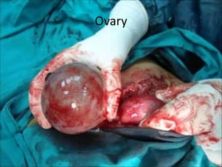 Ovary
 
