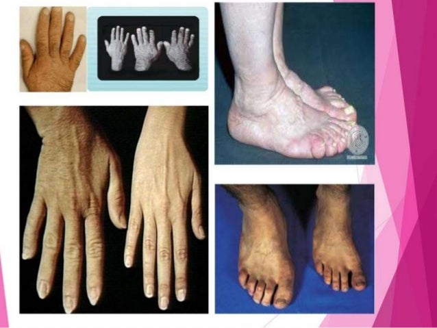 acromegaly,gigantism and dwarfism
