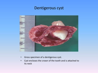 • Gross specimen of a dentigerous cyst.
• Cyst encloses the crown of the tooth and is attached to
its neck
Dentigerous cyst
 