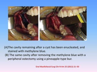 (A)The cavity remaining after a cyst has been enucleated, and
stained with methylene blue.
(B) The same cavity after removing the methylene blue with a
peripheral ostectomy using a pineapple-type bur.
Oral Maxillofacial Surg Clin N Am 25 (2013) 21–30
 