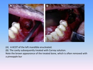 (A) A KCOT of the left mandible enucleated.
(B) The cavity subsequently treated with Carnoy solution.
Note the brown appearance of the treated bone, which is often removed with
a pineapple bur
 
