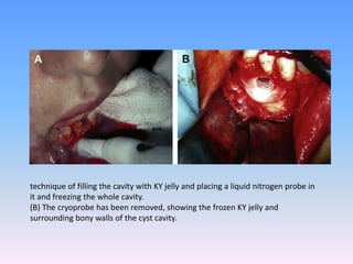 technique of filling the cavity with KY jelly and placing a liquid nitrogen probe in
it and freezing the whole cavity.
(B) The cryoprobe has been removed, showing the frozen KY jelly and
surrounding bony walls of the cyst cavity.
 