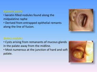 Epistein pearls
• keratin filled nodules found along the
midpalatine raphe
• Derived from entrapped epithelial remants
along the line of fusion.
Bohns nodules
• Cysts arising from remanants of mucous glands
in the palate away from the midline.
• Most numerous at the junction of hard and soft
palate.
 