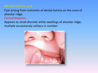 Dental lamina cyst
Cyst arising from remnants of dental lamina on the crest of
alveolar ridge.
Clinical features–
Appears as small discrete white swellings of alveolar ridge,
multiple occassionaly solitary in number.
 