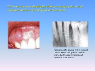 There may be no radiographic change or only a faint round
shadow indicative of superficial bone erosion.
Radiograph of a gingival cyst in an adult.
There is a faint radiographic shadow
(marked with arrows) indicative of
superficial bone erosion.
 