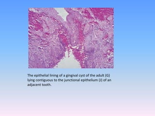 The epithelial lining of a gingival cyst of the adult (G)
lying contiguous to the junctional epithelium (J) of an
adjacent tooth.
 