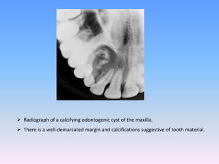  Radiograph of a calcifying odontogenic cyst of the maxilla.
 There is a well-demarcated margin and calcifications suggestive of tooth material.
 