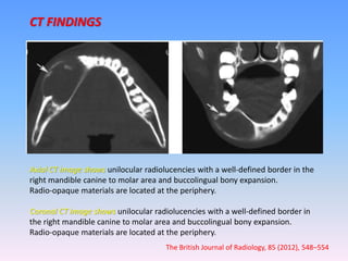 Axial CT image shows unilocular radiolucencies with a well-defined border in the
right mandible canine to molar area and buccolingual bony expansion.
Radio-opaque materials are located at the periphery.
Coronal CT image shows unilocular radiolucencies with a well-defined border in
the right mandible canine to molar area and buccolingual bony expansion.
Radio-opaque materials are located at the periphery.
CT FINDINGS
The British Journal of Radiology, 85 (2012), 548–554
 