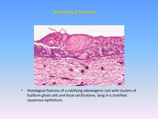 • Histological features of a calcifying odontogenic cyst with clusters of
fusiform ghost cells and focal calcifications, lying in a stratified
squamous epithelium.
Histological features
 